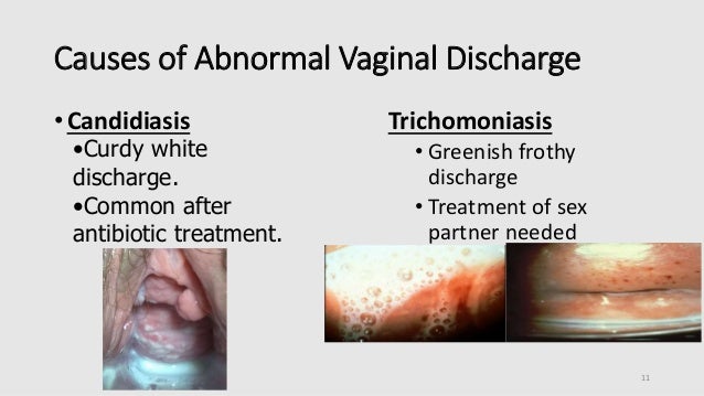 white vaginal discharge std Aurora jolie pornstar